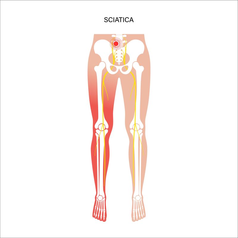 Muscular illustration of the pelvis and legs that shows the sciatic nerve's path. 